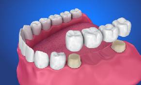 best Crown and bridges in pune, Laxmi road, Camp